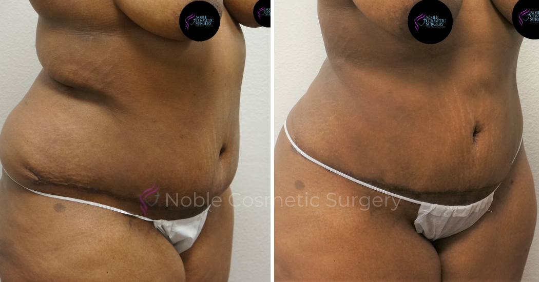 TUMMY-TUCK-CASE-00042 | Before and After Abdominoplasty 2