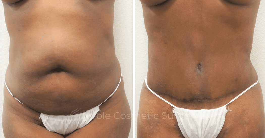 TUMMY-TUCK-CASE-00305 | Before and After Abdominoplasty 1