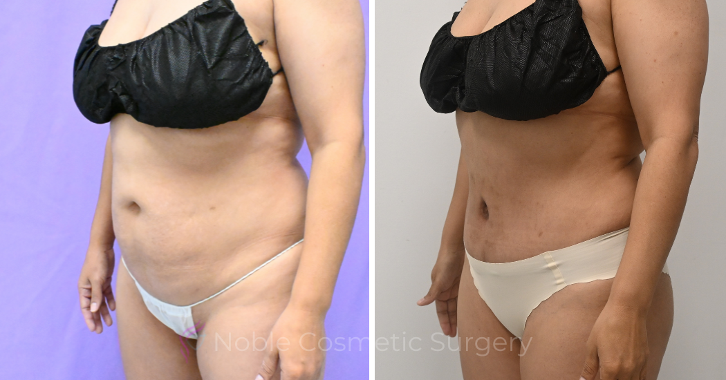 Case--20157 | Before and After Abdominoplasty 2