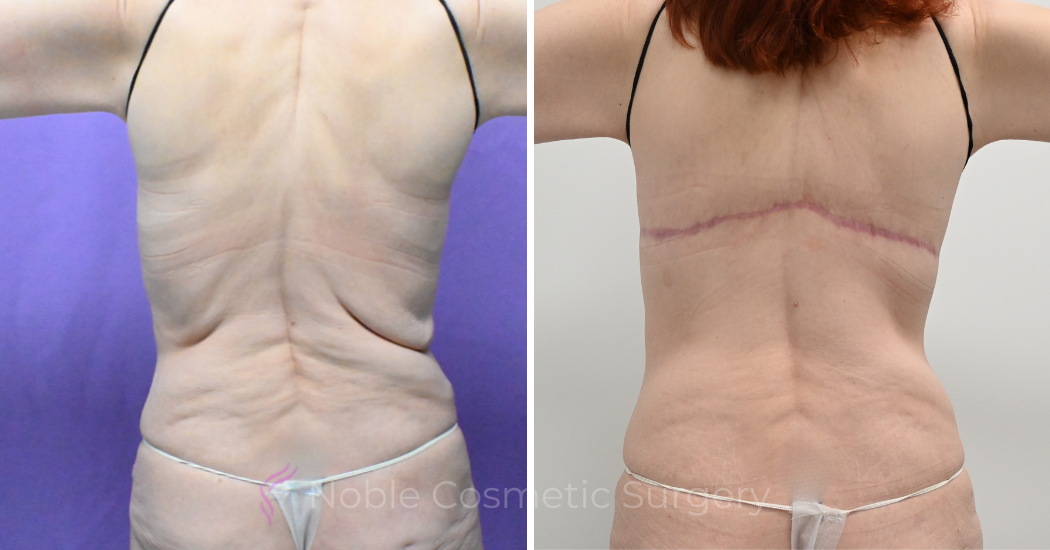 Case--12099 | Before and After Back Lift 2