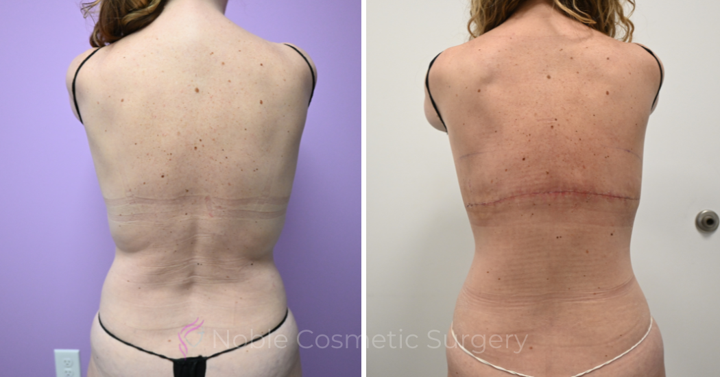 Case--20309 | Before and After Back Lift 2