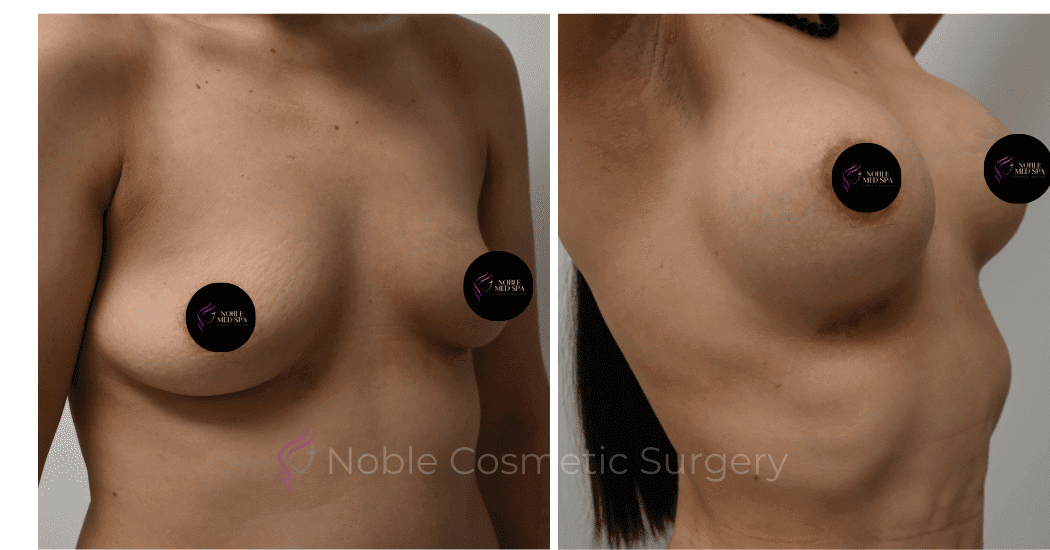 BREAST-AUGMENTATION-CASE-11661 | Before and After Breast Augmentation 2