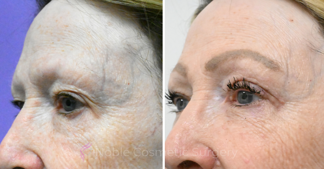 Case--18940 | Before and After Blepharoplasty 2