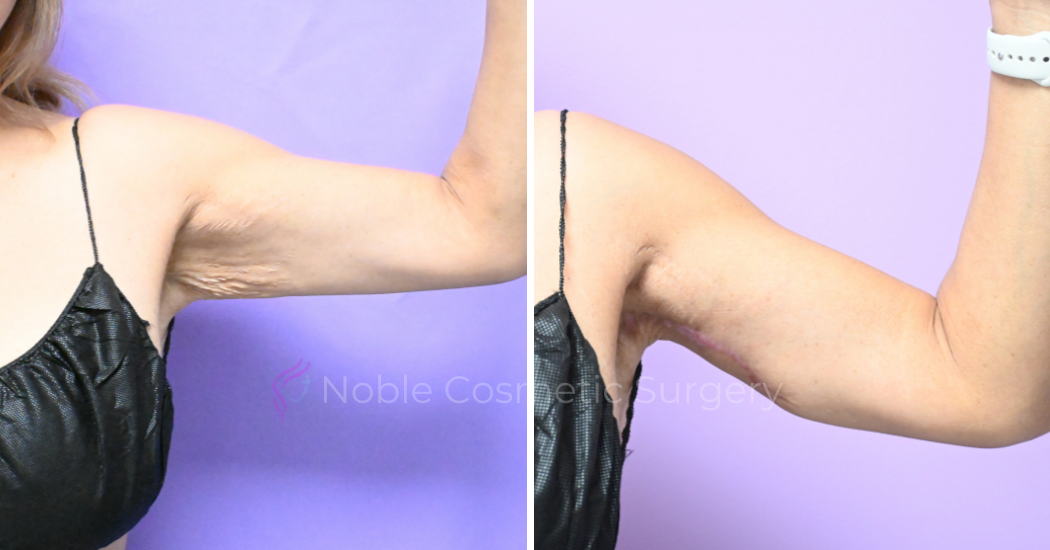 Case--20186 | Before and After Brachioplasty 2