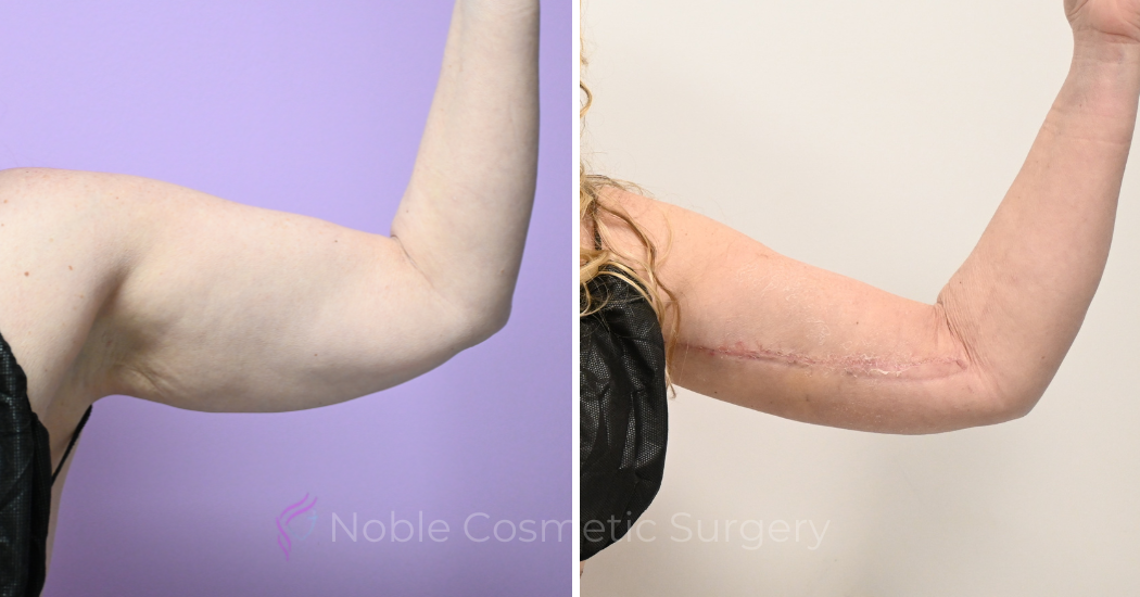 Case--20309 | Before and After Brachioplasty 2