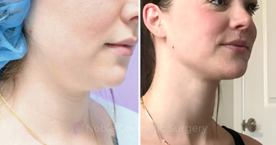Case--20184 | Before and After Chin Liposuction 2
