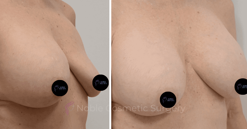 BREAST-AUGMENTATION-CASE-12085 | Before and After Breast Augmentation 2