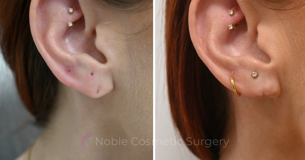 Case--20318 | Before and After Earlobe Repair 2