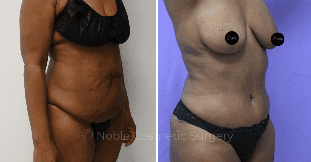 TUMMY-TUCK-CASE-10375 | Before and After Abdominoplasty 2
