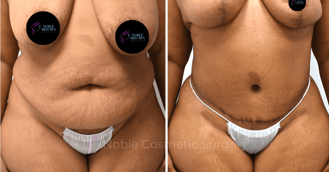TUMMY-TUCK-CASE-00309 | Before and After Abdominoplasty 1