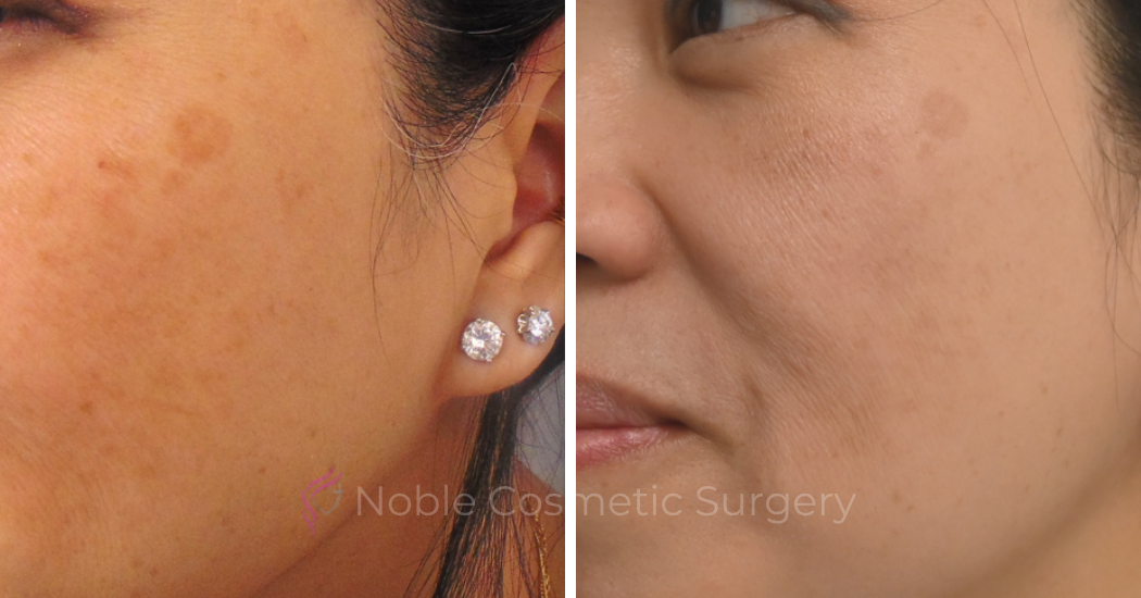 PICO-LASER-CASE-00003 | Before and After Pico Skin Rejuvenation 2