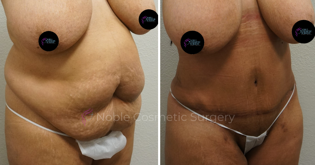 TUMMY-TUCK-CASE-00043 | Before and After Abdominoplasty 2