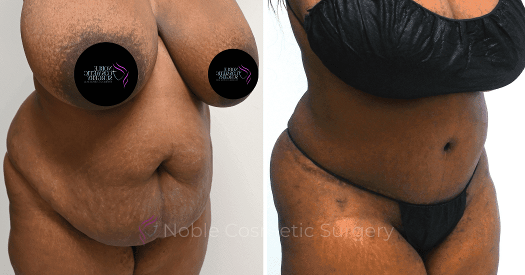 TUMMY-TUCK-CASE-11720 | Before and After Abdominoplasty 2