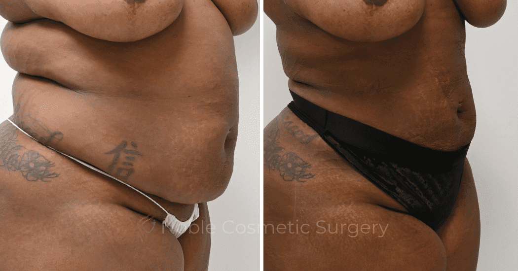 LIPOSUCTION-ABDOMEN-CASE-15837 | Before and After Liposuction 2