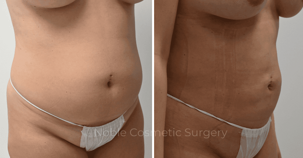 LIPOSUCTION-CASE-11801 | Before and After Liposuction 2
