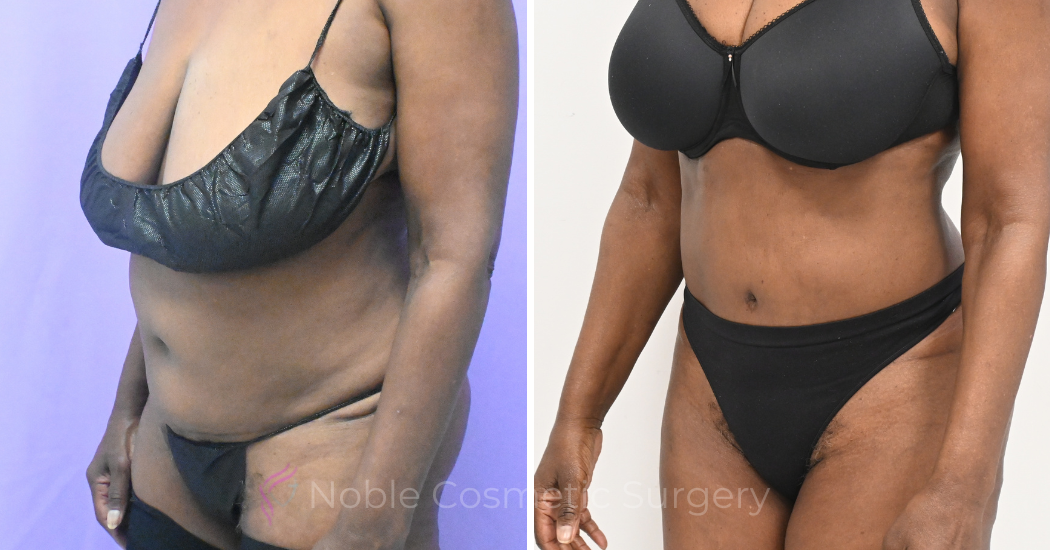 Case--19632 | Before and After Liposuction 2