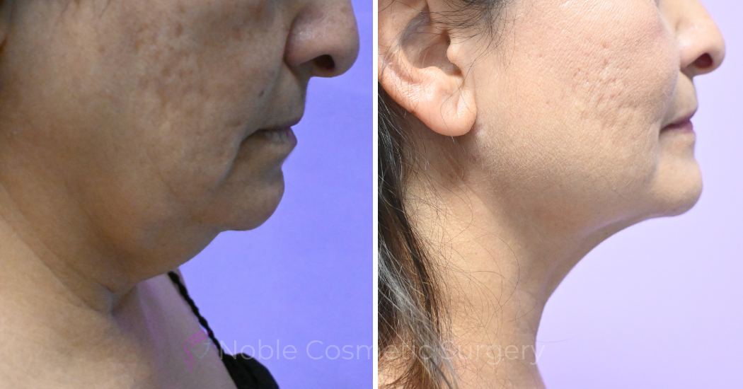 Case--19506 | Before and After Chin Liposuction 2