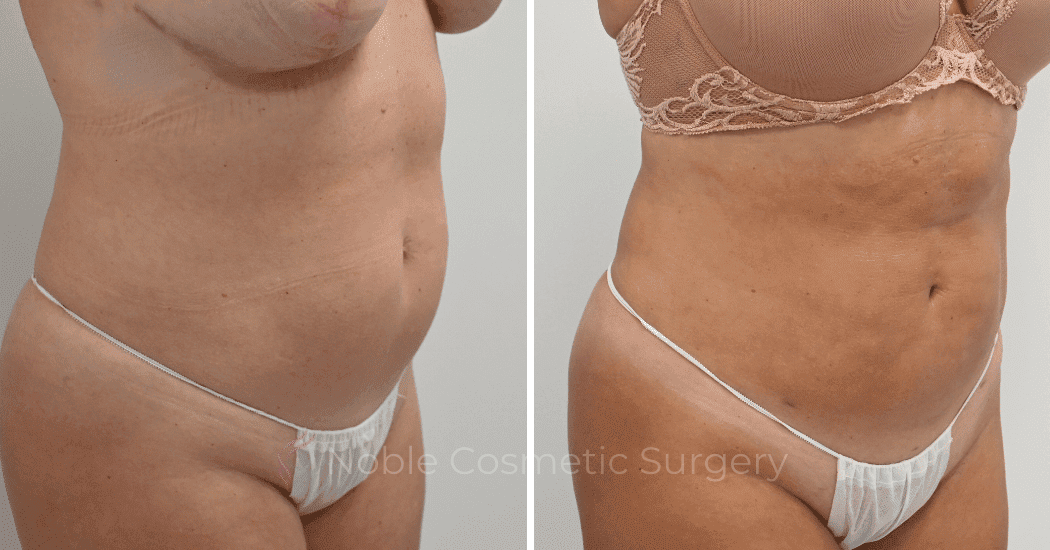 LIPOSUCTION-CASE-13006 | Before and After Liposuction 2