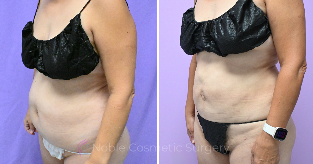 Case---19506 | Before and After Liposuction 2