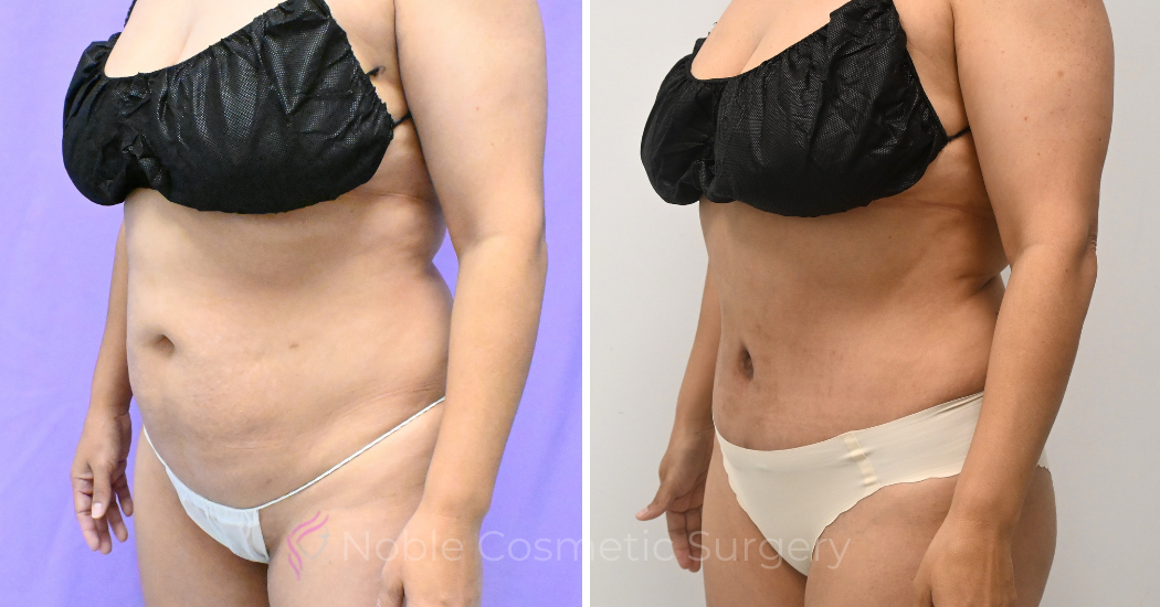 Case--20157 | Before and After Abdominoplasty 2