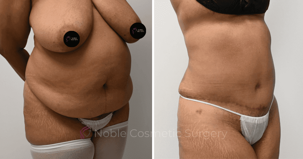 TUMMY-TUCK-CASE-11110 | Before and After Abdominoplasty 2
