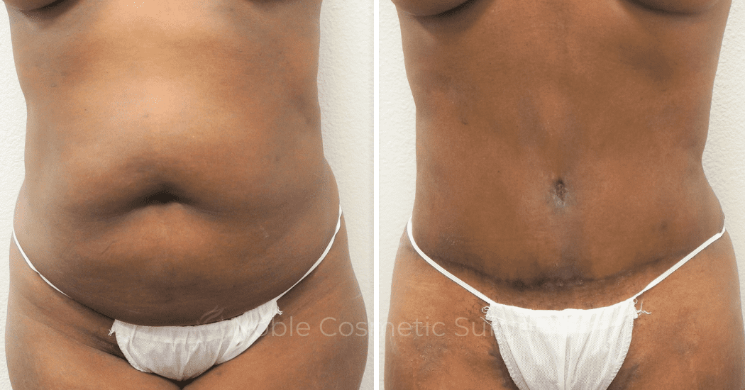 MOMMY-MAKEOVER-CASE-00305 | Before and After Mommy Makeover