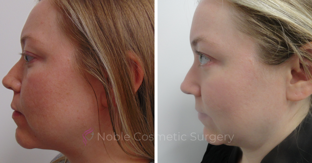 PICO-LASER-CASE-00005 | Before and After Pico Skin Rejuvenation 3