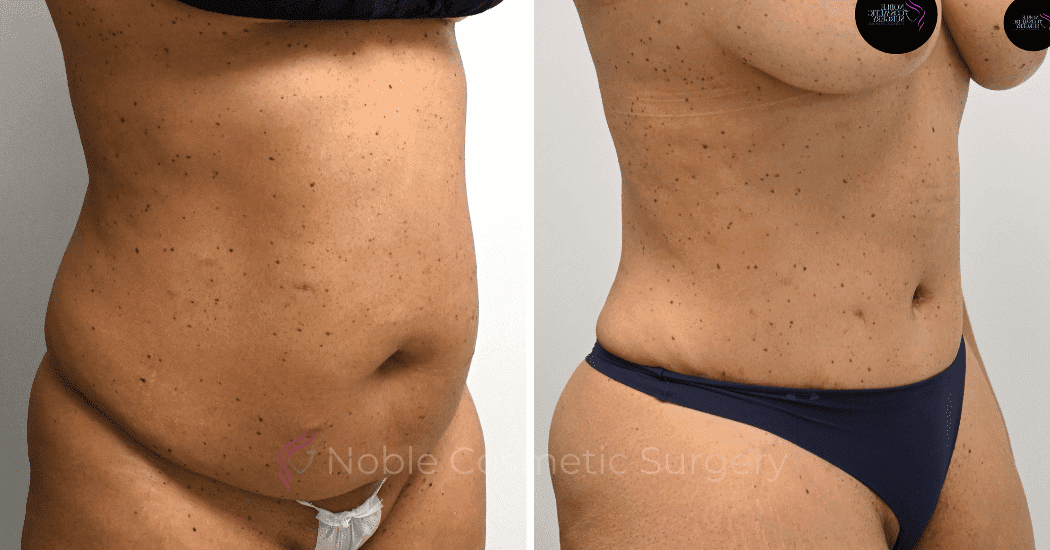 TUMMY-TUCK-CASE-10616 | Before and After Abdominoplasty 2