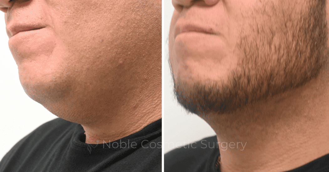 SUBMENTAL-LIPOSUCTION-CASE-19137 | Before and After Chin Liposuction