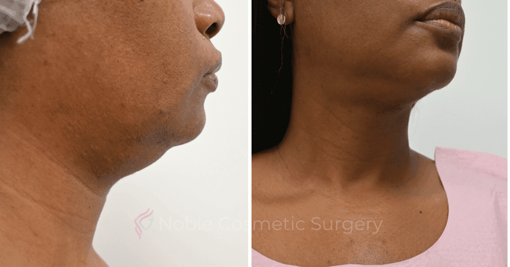 SUBMENTAL-LIPOSUCTION-CASE-12998 | Before and After Chin Liposuction 3