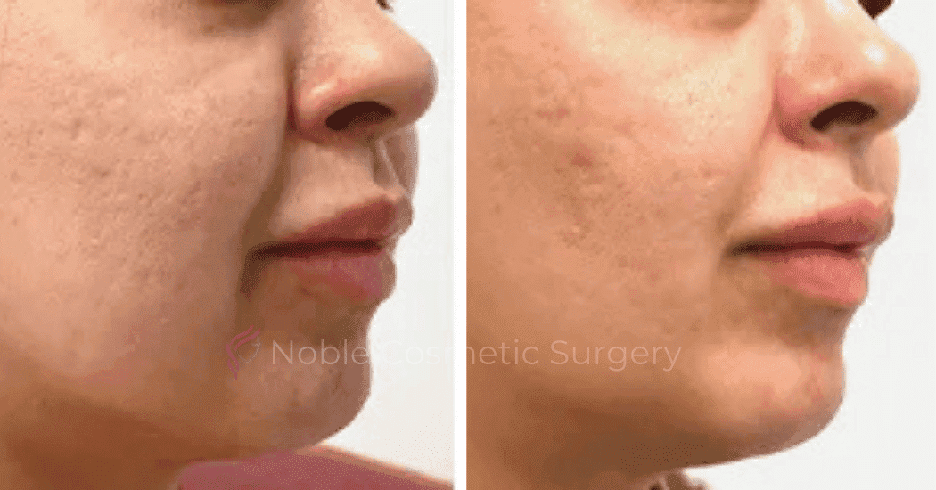 DERMAL-FILLERS-CASE-00259 | Before and After Dermal Fillers 2