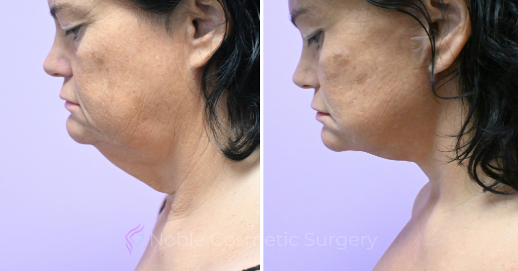 Case--5722 | Before and After Facelift 2