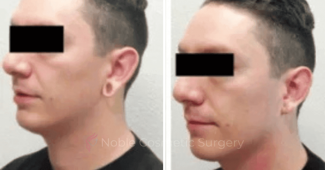 Earlobe-Repair-Case-20254 | Before and After Earlobe Repair