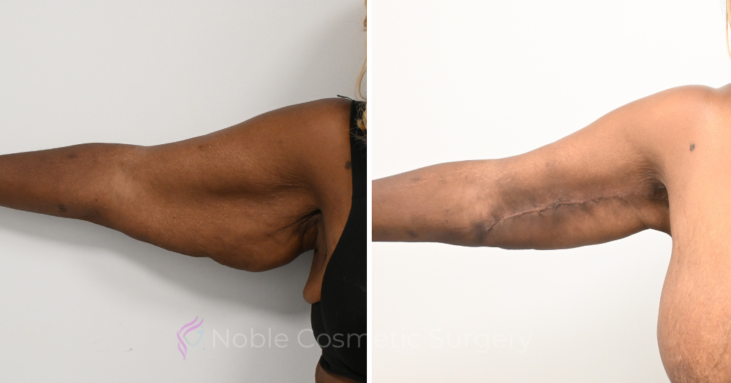 Case--20391 | Before and After Brachioplasty