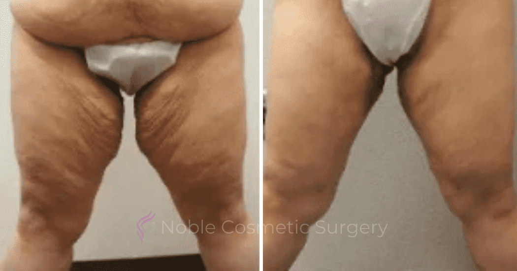 Thigh-Lift-Case-10386 | Before and After Thigh Lift 2