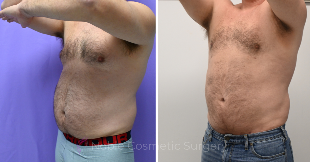 Case--13711 | Before and After Male Liposuction 2