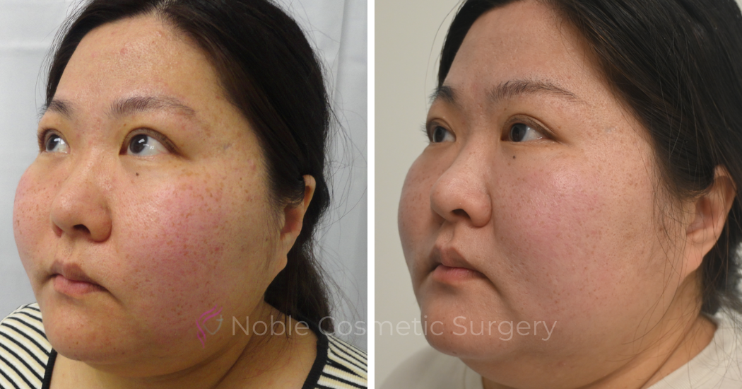 PICO-LASER-CASE-00006 | Before and After Pico Skin Rejuvenation 2