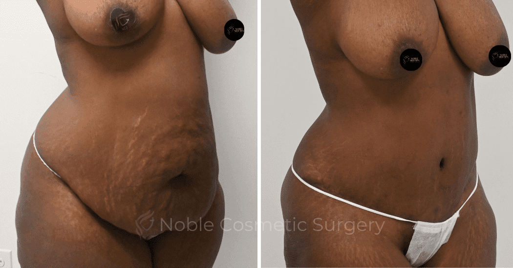 TUMMY-TUCK-CASE-10563 | Before and After Abdominoplasty 2