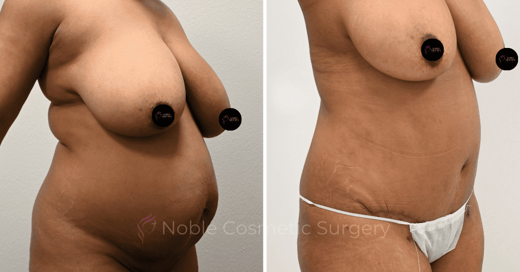 TUMMY-TUCK-CASE-14407 | Before and After Abdominoplasty 2
