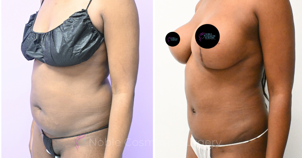 Case--20347 | Before and After Abdominoplasty 2