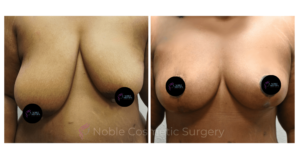 BREAST-REDUCTION-CASE-00801 | Before and After Breast Reduction