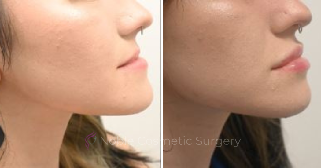 DERMAL-FILLERS-CASE-00265 | Before and After Dermal Fillers 2