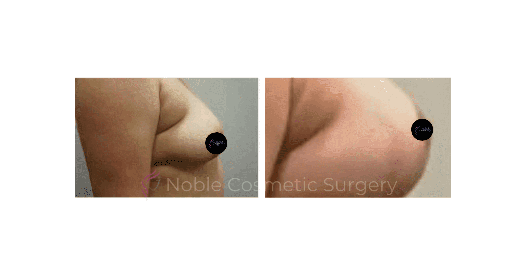 BREAST-LIFT-CASE-00510 | Before and After Breast Lift 2