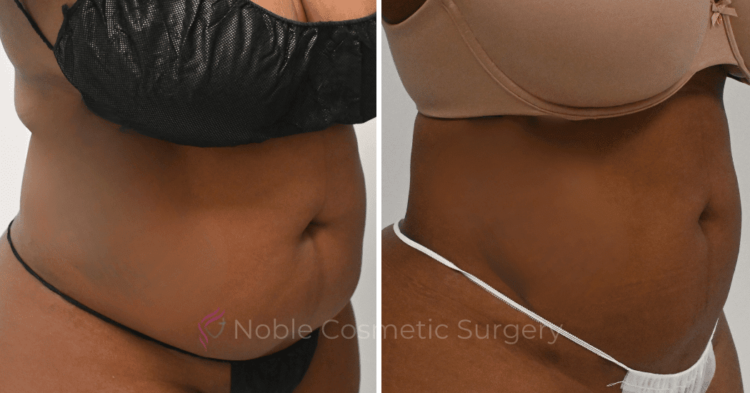 LIPOSUCTION-CASE-10271 | Before and After Liposuction 2