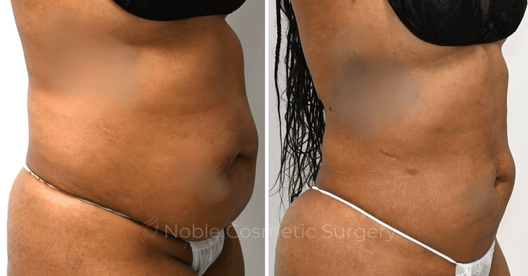 LIPOSUCTION-CASE-10929 | Before and After Liposuction 2