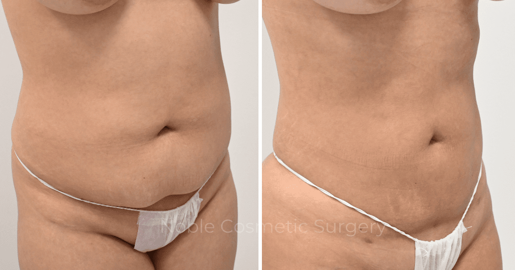 LIPOSUCTION-CASE-12977 | Before and After Liposuction 2