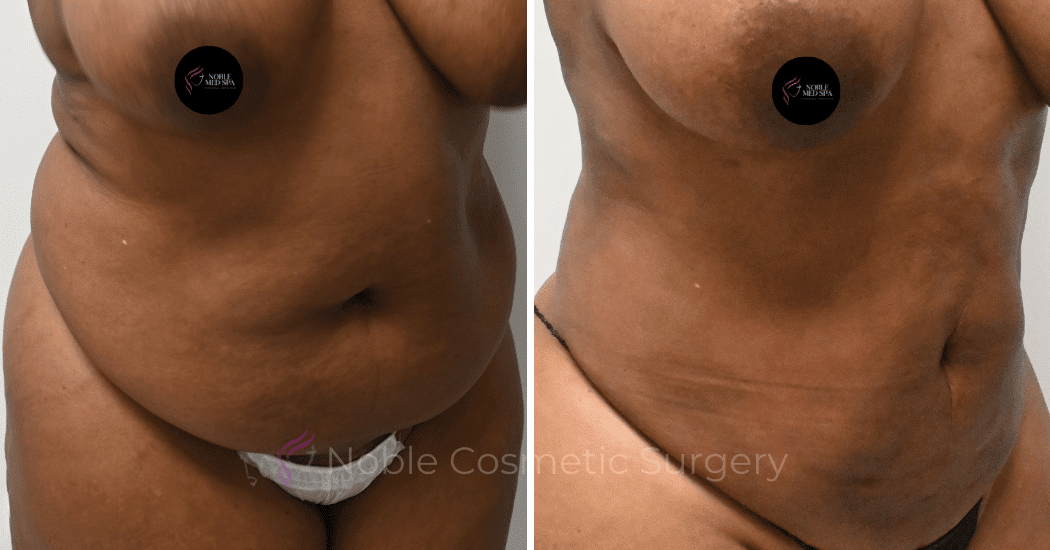 LIPOSUCTION-CASE-13371 | Before and After Liposuction 2