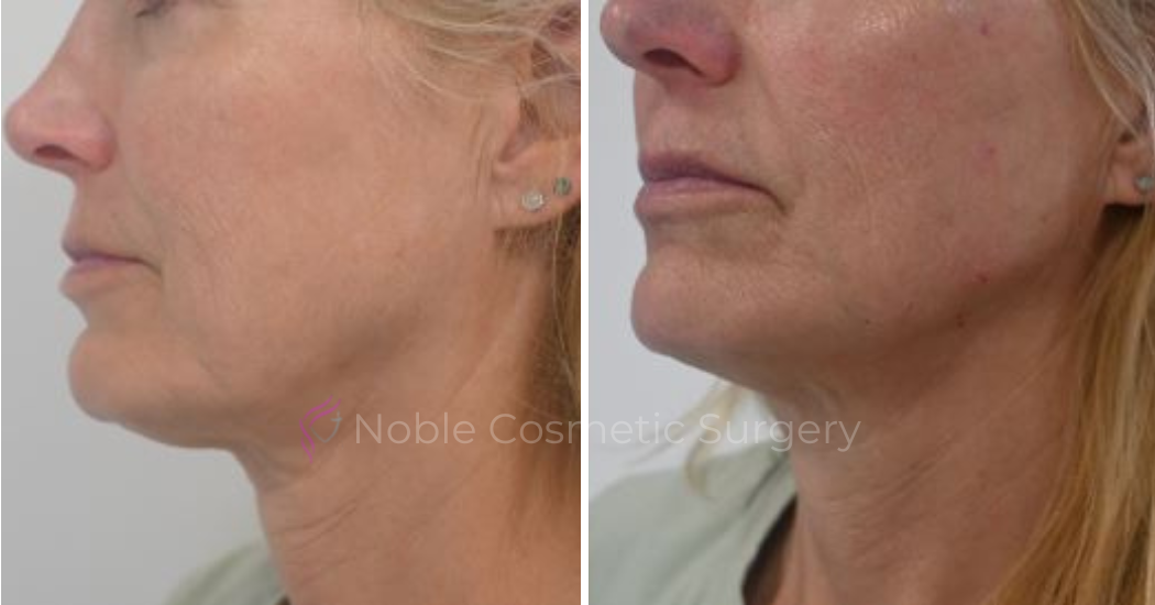 RF-MICRONEEDLING-CASE-00050 | Before and After RF Microneedling 3