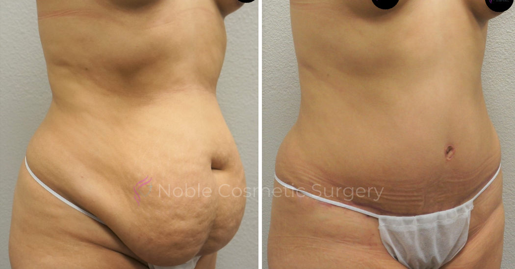 TUMMY-TUCK-CASE-00048 | Before and After Abdominoplasty 2