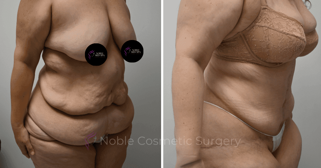 TUMMY-TUCK-CASE-10950 | Before and After Abdominoplasty 2